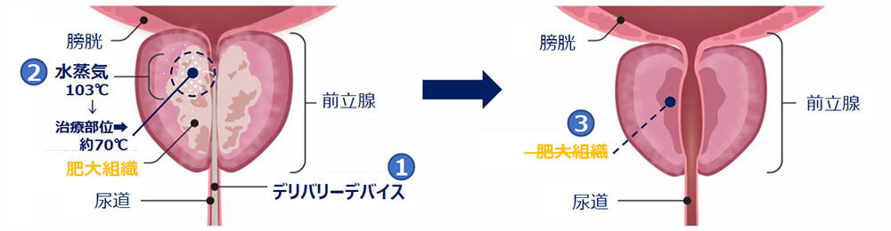 前立腺肥大症の手術方法のイラスト